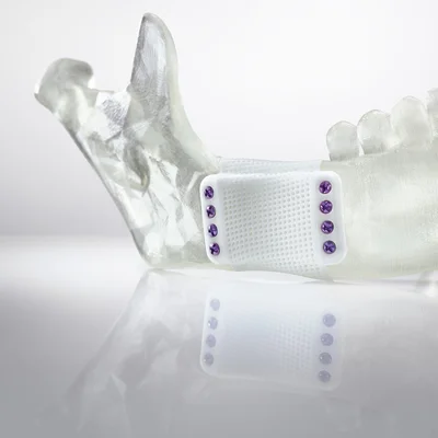 Additiv gefertigtes keramisches Kieferimplantat 